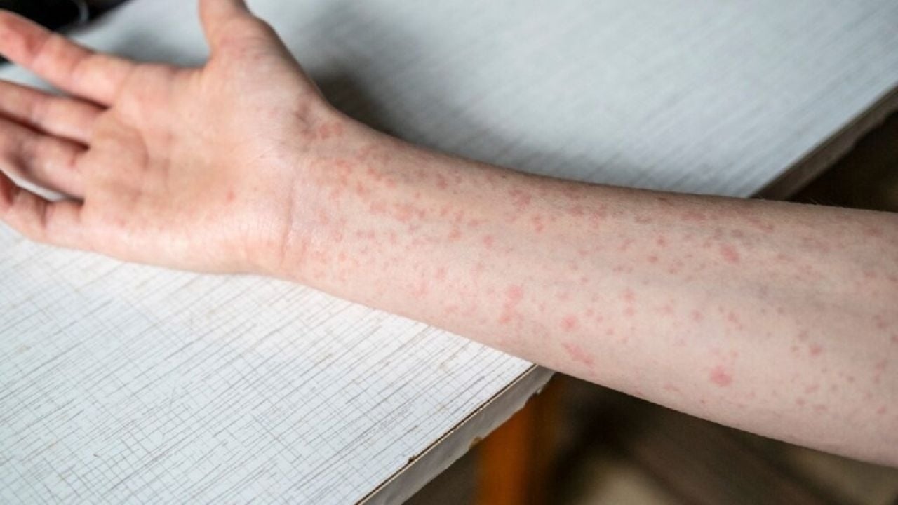 There are 12 deaths from measles and about 3,500 cases in Mexico.